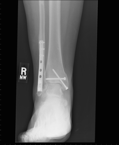 tami_wendell_ankle_x-ray_06-20-2006.jpg