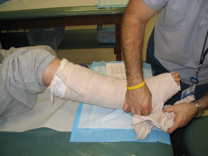 broken leg in cast. Tami#39;s Broken Leg Page of