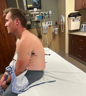 Hiking Pole Injury in Montana - 07-20-2026